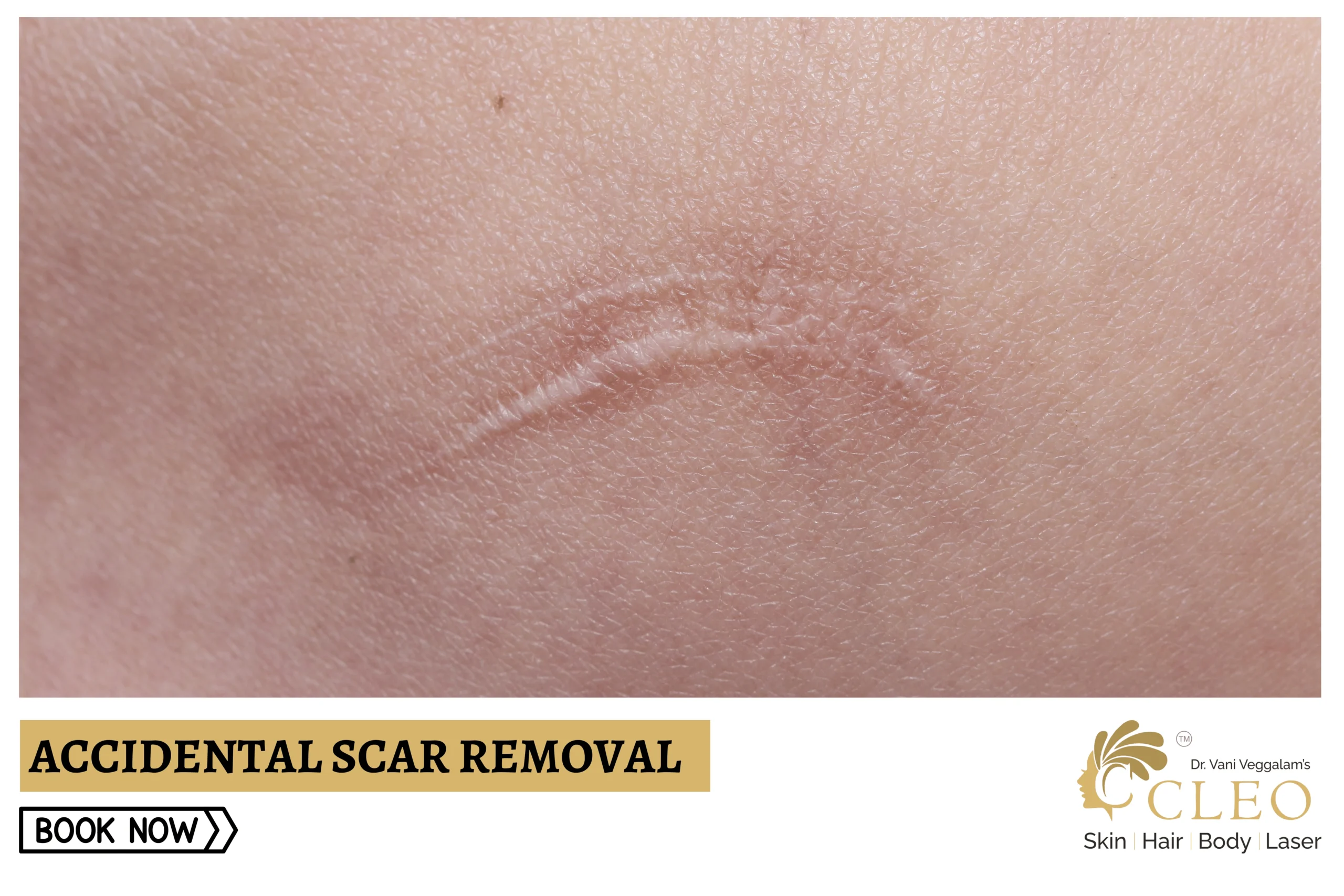 Surgical Scar Removal – Cleo Skin Clinic