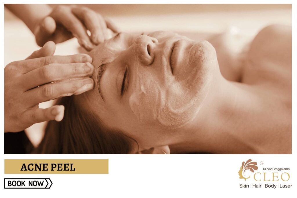 Combat Acne with Acne Peel at Cleo Skin Clinic, Hyderabad