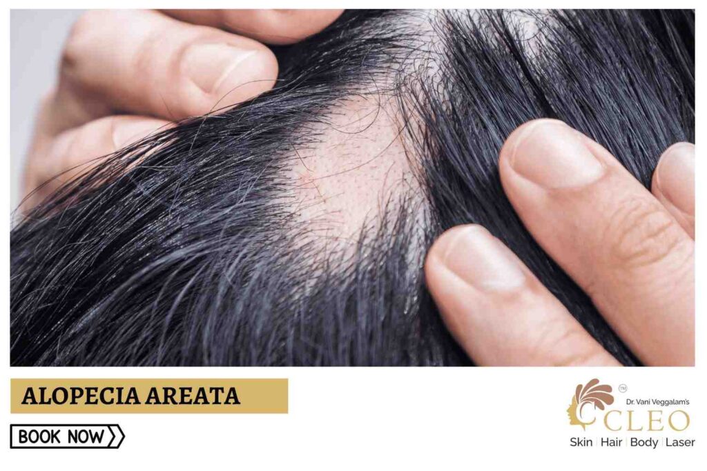 Alopecia Areata: Comprehensive Treatment at Cleo Skin Clinic, Hyderabad