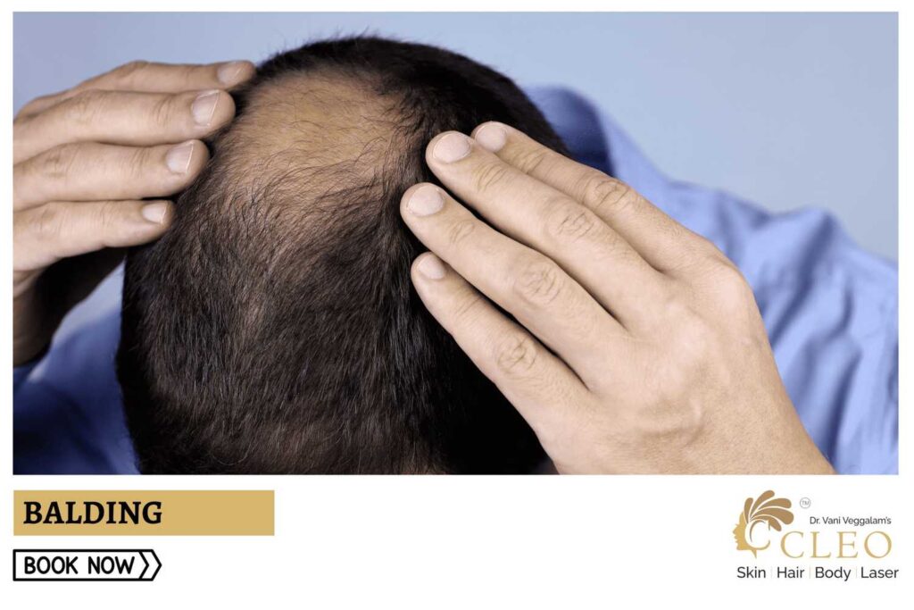 Treatment for Balding: Effective Solutions at Cleo Skin Clinic, Hyderabad