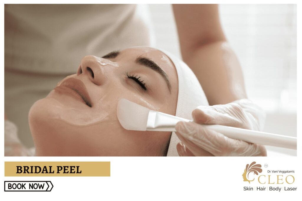 Achieve Glowing Skin for Your Special Day with Bridal Peel at Cleo Skin Clinic, Hyderabad