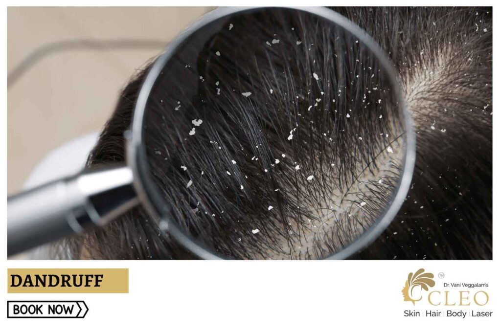 Dandruff Treatment: Say Goodbye to Flakes at Cleo Skin Clinic, Hyderabad