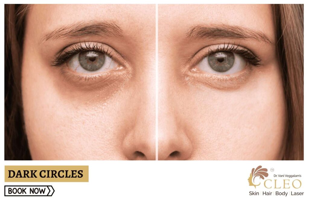 Say Goodbye to Dark Circles with Under Eye Fillers at Cleo Skin Clinic, Hyderabad