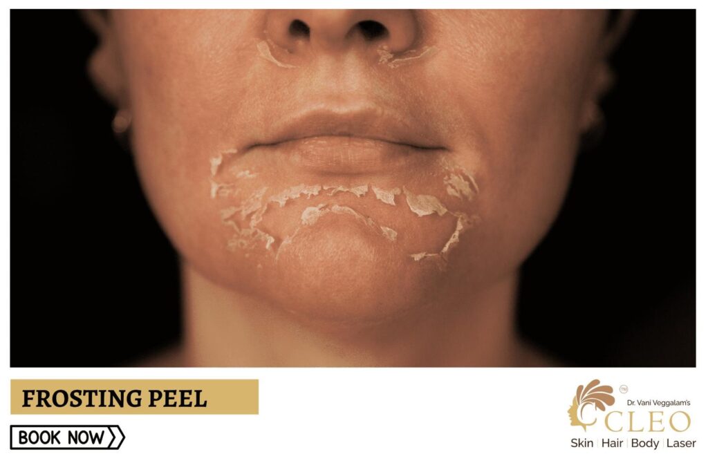 Rejuvenate Your Skin with Frosting Peel at Cleo Skin Clinic, Hyderabad