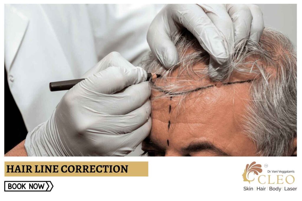 Hair Line Correction: Perfect Hairline Solutions at Cleo Skin Clinic, Hyderabad