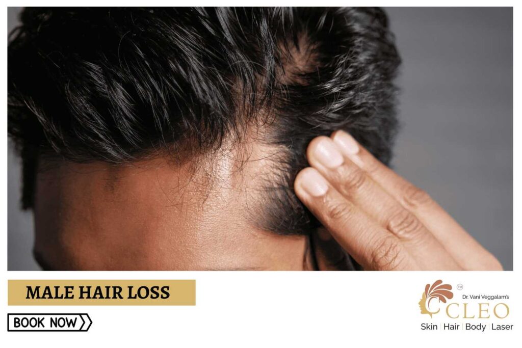 Male Hair Loss: Effective Solutions at Cleo Skin Clinic, Hyderabad