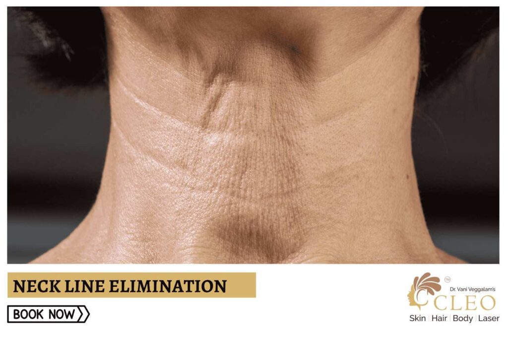 Achieve a Defined Neck with Neck Line Elimination at Cleo Skin Clinic, Hyderabad