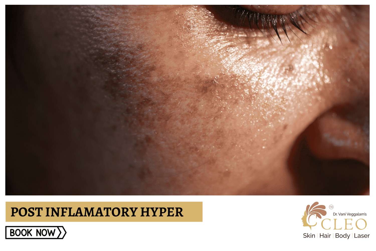 Post Inflammatory Hyperpigmentation Cleo Skin Clinic Post Inflammatory Hyperpigmentation Cleo Skin Clinic