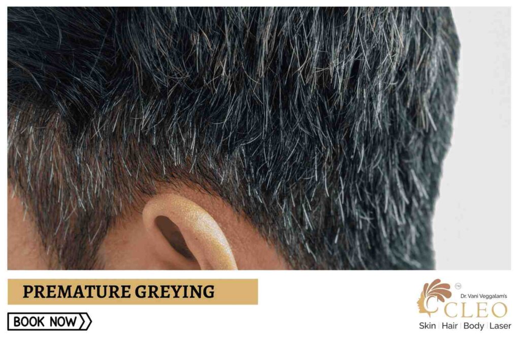 Reverse Premature Greying with Advanced Treatments at Cleo Skin Clinic, Hyderabad