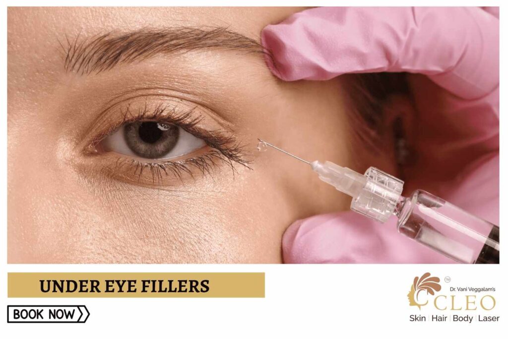 Rejuvenate Your Eyes with Under Eye Fillers at Cleo Skin Clinic, Hyderabad