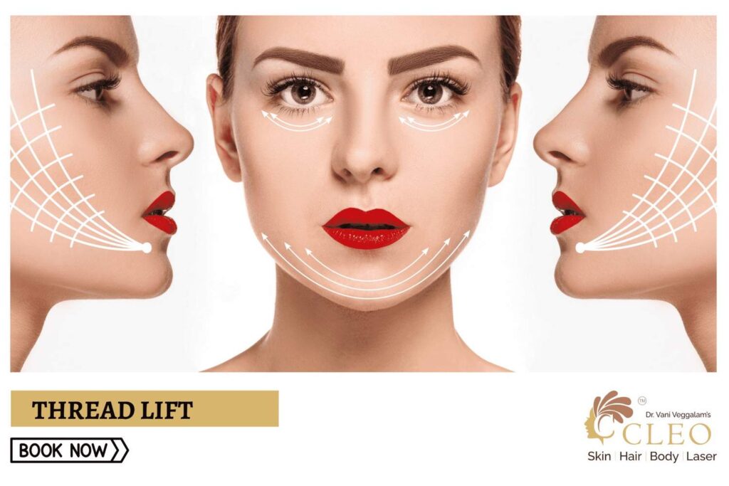 Elevate Your Appearance with Thread Lift at Cleo Skin Clinic, Hyderabad