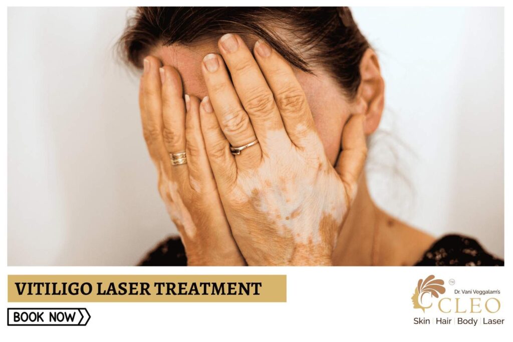 Say Goodbye to Vitiligo with Laser Treatment at Cleo Skin Clinic, Hyderabad