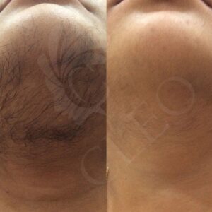 Hair-Removal-in-5-sessions.jpg