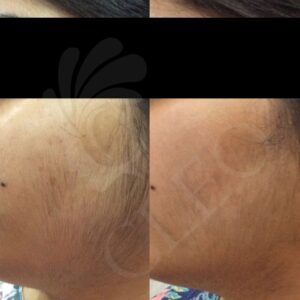 Hair-Removal-result-having-PCOD.jpg