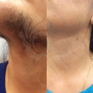 Thick-hair-Removal-with-our-USFDA-Approved-laser.jpg