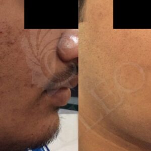 acne-acne-marks-and-pigmentation.jpg