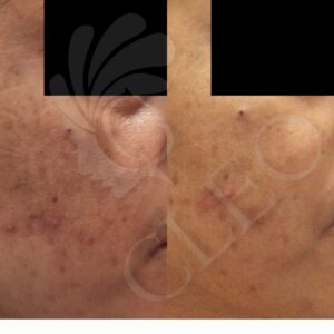 melasma-1.jpg