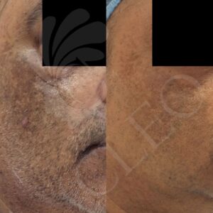 melasma.jpg