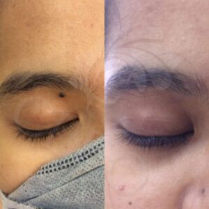 safe-mole-removal-on-the-eyelid.jpg