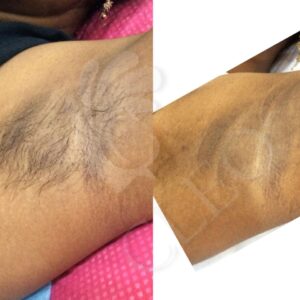 under-arm-hair-removal.jpg