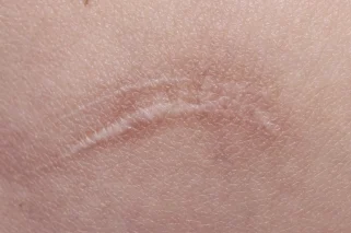 ACCIDENTAL SCAR REMOVAL